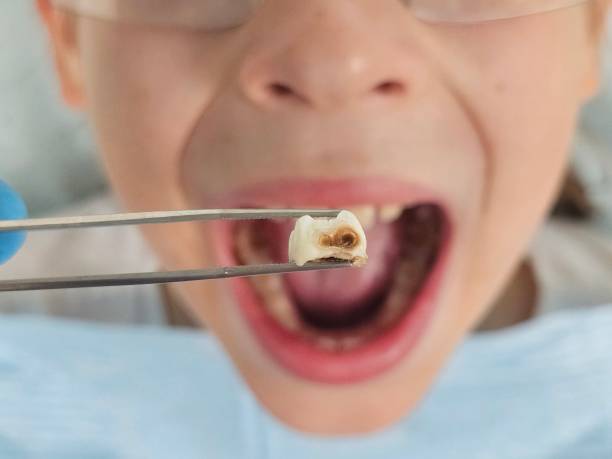 Best Broken or Cracked Tooth Emergency Dentist in College Place, WA